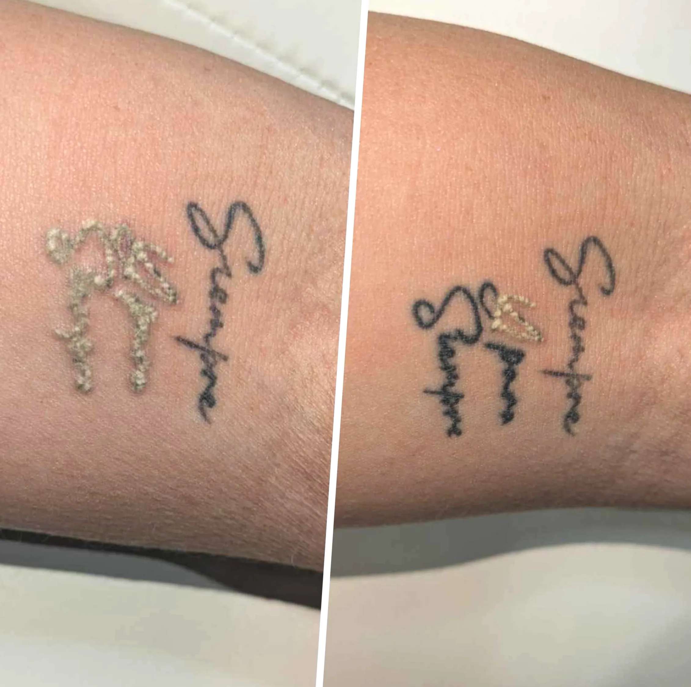 laser tattoo removal Melbourne