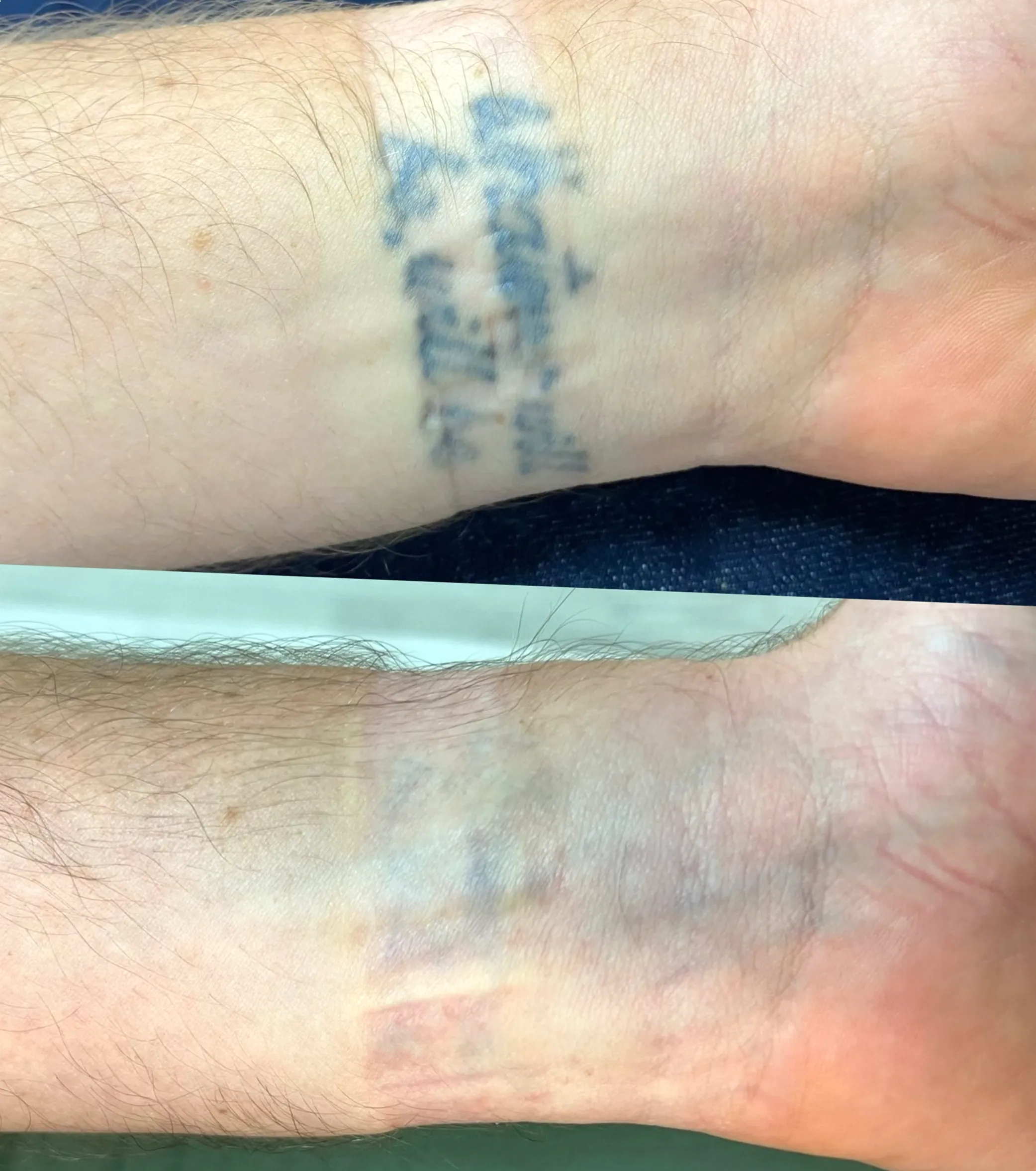 tattoo fading prevention